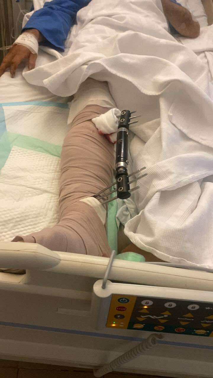 خلاف على صرف الدولار ينتهي ببتر ساق شاب سوري في بعلبك 1