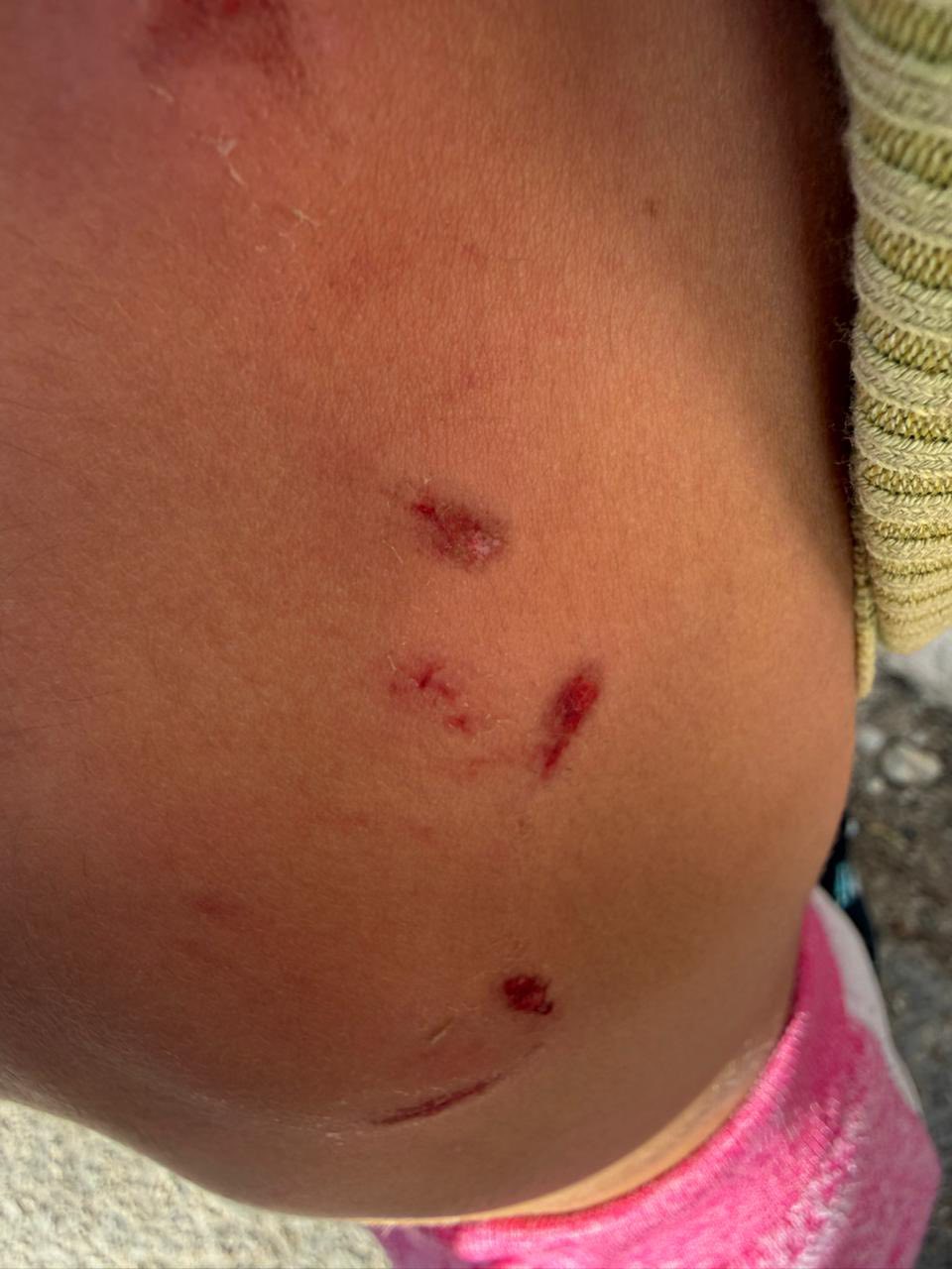 بالصور جنوبا: كلب شارد شرس يعض الطفلة جوليا ويسبب لها عدة جروح !