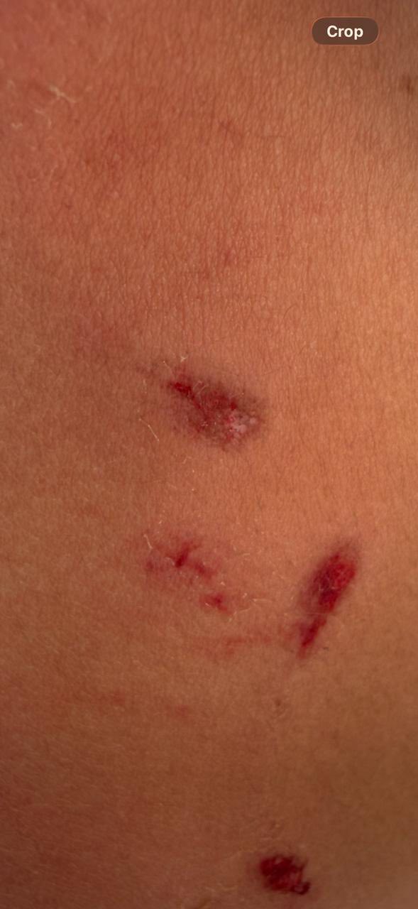 بالصور جنوبا: كلب شارد شرس يعض الطفلة جوليا ويسبب لها عدة جروح !