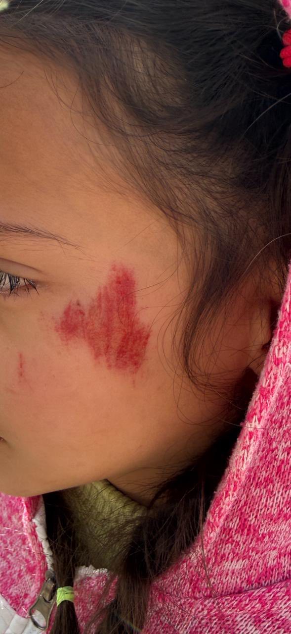 بالصور جنوبا: كلب شارد شرس يعض الطفلة جوليا ويسبب لها عدة جروح !