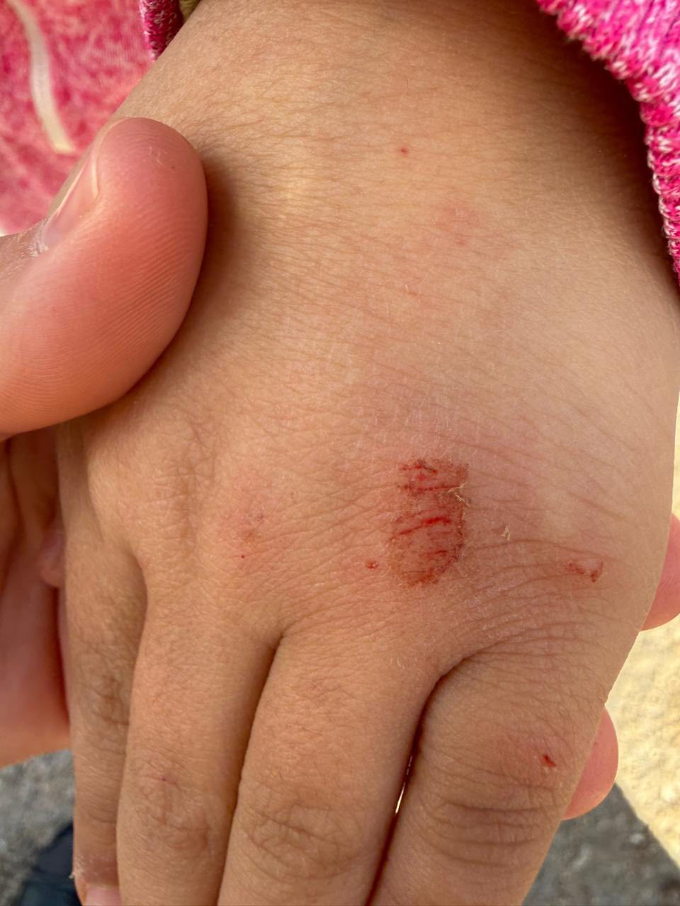 بالصور جنوبا: كلب شارد شرس يعض الطفلة جوليا ويسبب لها عدة جروح !