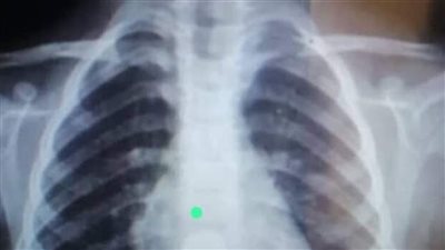 ابن الـ 5 سنوات ابتلع بطارية.. هكذا تم سحبها بعد 6 أيام