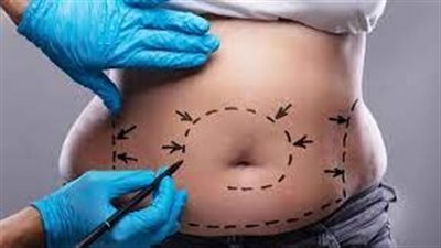  عملية شفط الدهون: الإجراء التجميلي الأكثر أماناً على الإطلاق.. وهذه التفاصيل!