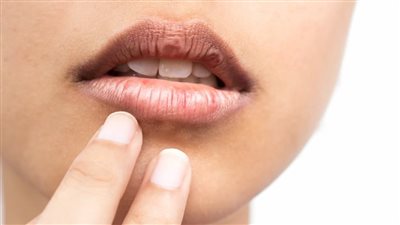 تستخدم لإزالة التجاعيد وتنعيم الوجه... مادة هلامية شائعة قد تساعد على معالجة جفاف الفم المزمن!