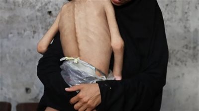المجاعة لا تنتهي بالغذاء.. بل يترك ندوبًا في الجينات تمتد لأجيال