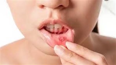 5 علامات مبكرة لسرطان الفم.. تجاهلها قد يكون قاتلًا