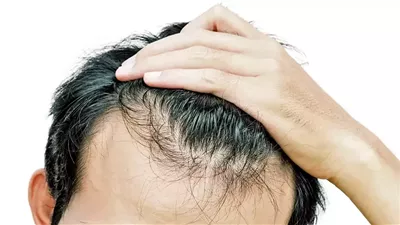هل تعانون من تساقط الشعر؟ اليكم هذا الحل الطبيعي