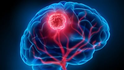 7 أعراض قد تشير إلى الإصابة بسرطان الدماغ.. ما هي؟