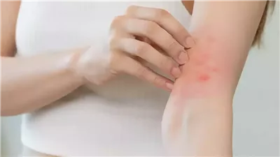 كيف تتغلبين على الأكزيما العصبية؟